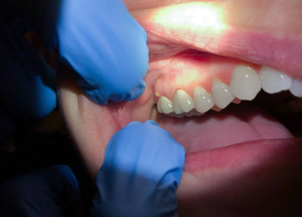 Best Emergency Treatment for Dental Infections or Abscesses in Brittany Farms The Highlands, PA